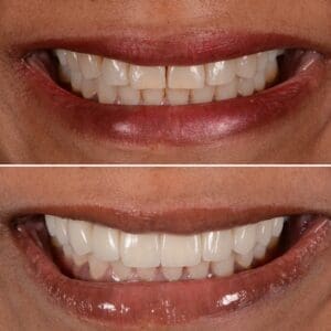Before and after Dr Preya